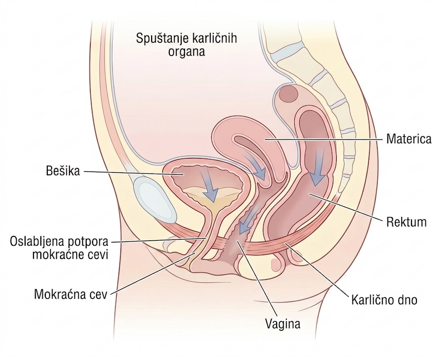 Prolaps karličnih organa