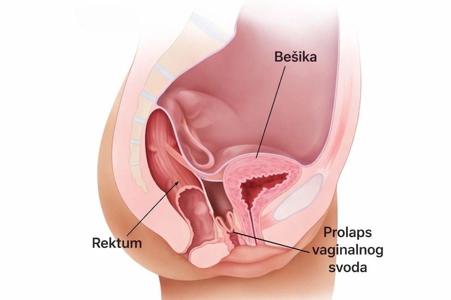 Prolaps vagine